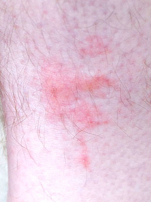 Those who have bed bugs rash want to know what caused the rash and how ...